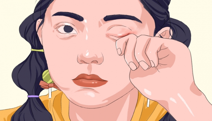 浙江女子一到晚上眼睛就发痒 睫毛上附着10个灰白色虫体蠕动